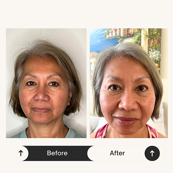 Cheek filler before and after at ZK Aesthetics