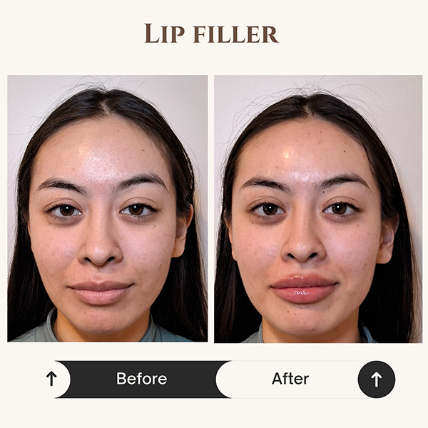 Lip filler before and after at ZK Aesthetics
